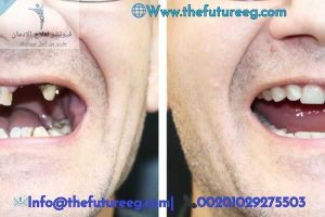 تأثير الشبو على الأسنان