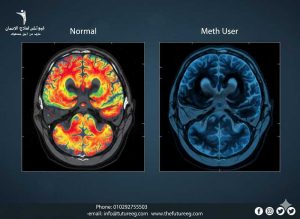 مقارنة أشعة الدماغ توضح تأثير الآيس على الدماغ الطبيعي.
